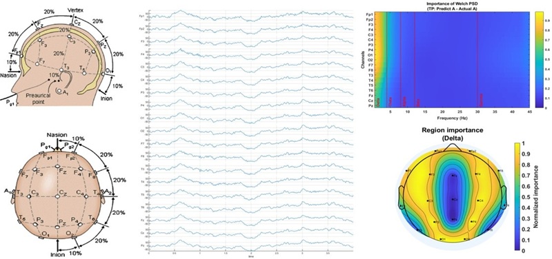 EEG sensors record brain activity (left), generating brainwave signals (middle) that are analyzed by explainable AI (top right) and mapped onto brain regions (bottom right) to detect and interpret dementia type and severity noninvasively.