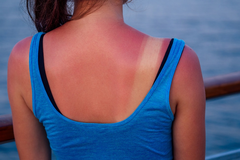 Sunburn, Woman, Beach